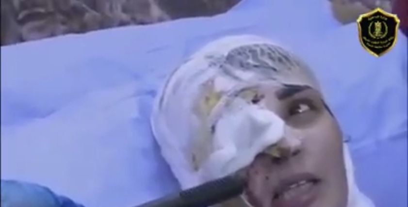 السيدة العراقية بعد تشوه وجهها