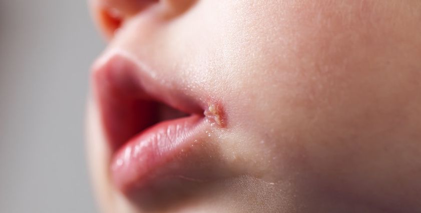 أعراض الهربس