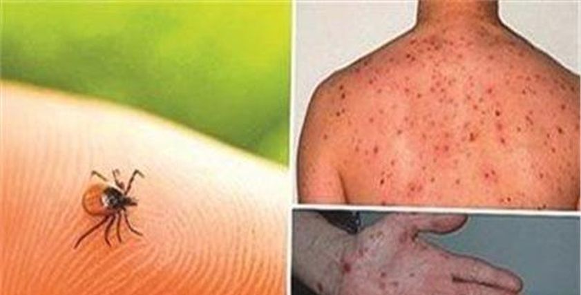 حمى الضنك النزفية