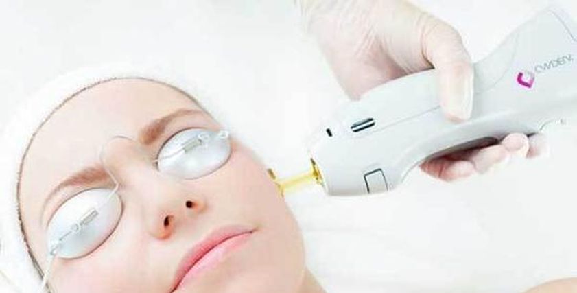 إزالة الشعر بالليزر
