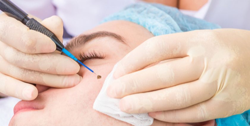 حكم عملية التجميل لإخفاء الحسنة