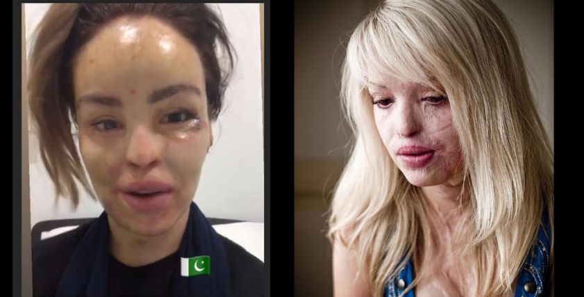 كاتى قبل وبعد عمليات التجميل