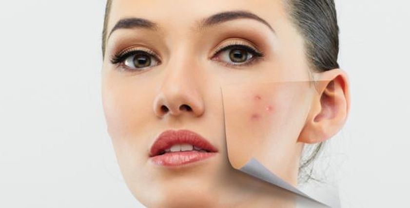 لاصحاب البثور السوداء وحب الشباب عليكم أستخدام حمض الساليسيليك