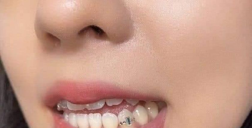 تسوس الأسنان - تعبيرية