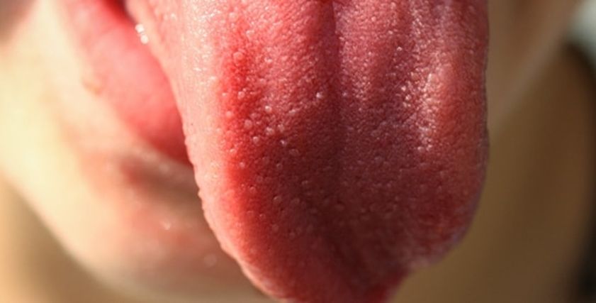 أمراض تصيب اللسان