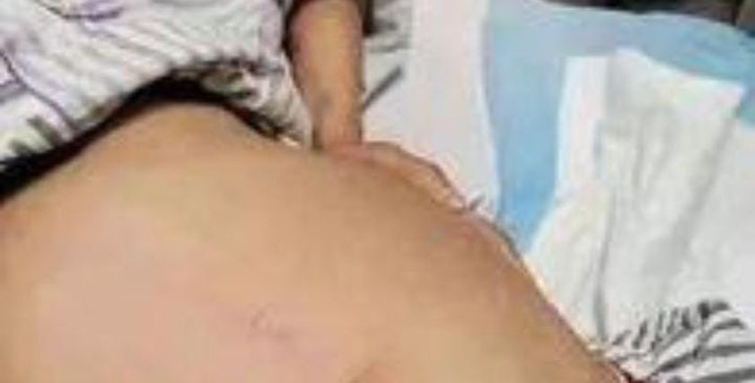 ما هو داء هيرشسبُرونغ سيدة صينية أُصيبت به.. ما القصة؟