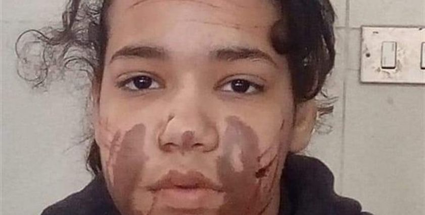 الطفلة آية ضحية تعذيب والدها