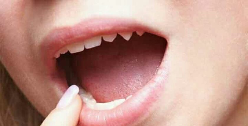 أعراض أمراض اللسان