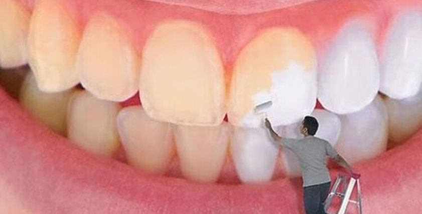 البقع البنية في الأسنان وعلاجها