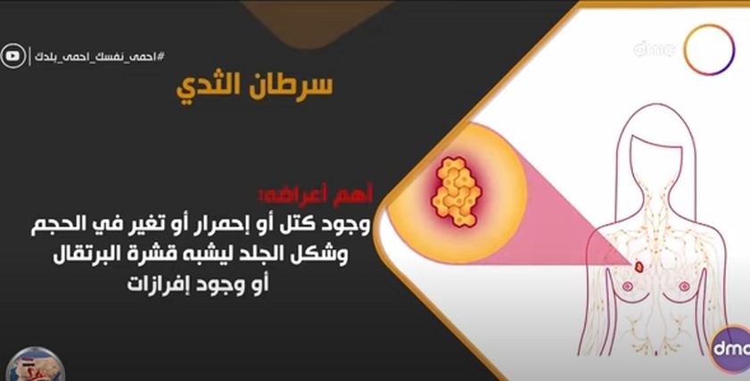 سرطان الثدي