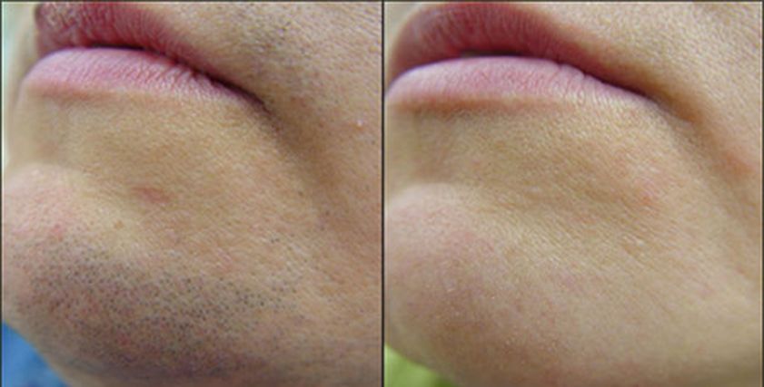 نصائح لإزالة شعر الوجه