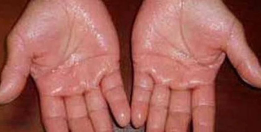طُرق لعلاج تعرق اليدين