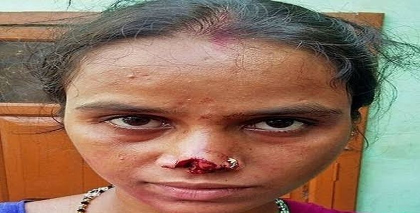 صورة أرشيفية لسيدة زوجها قطع أنفها