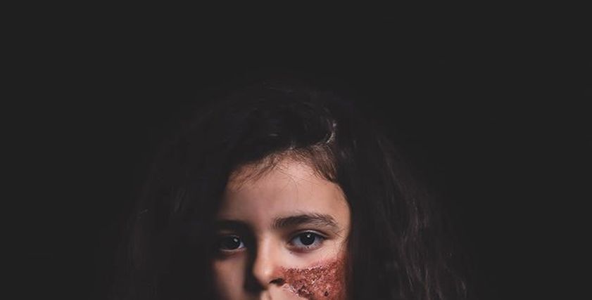 بالمكياج والدم الصناعي.. كواليس جلسة تصوير تجسد حروق الأطفال.. 