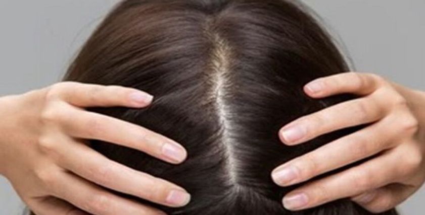 أمراض فروة الرأس في الشتاء- تعبيرية