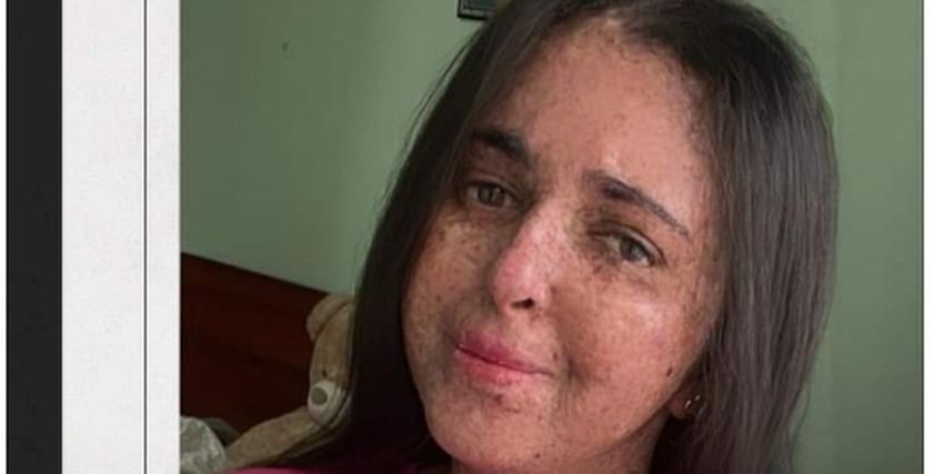 مرض نادر يعرض«فاطمة الزهراء»للتنمر