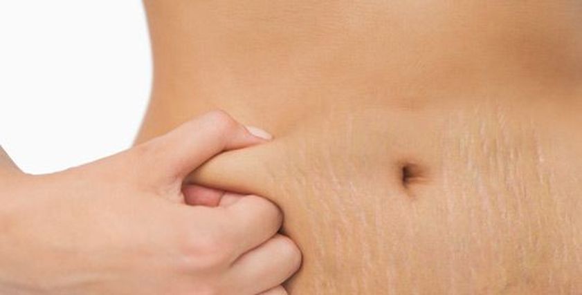 مواد طبيعية لعلاج علامات التمدد