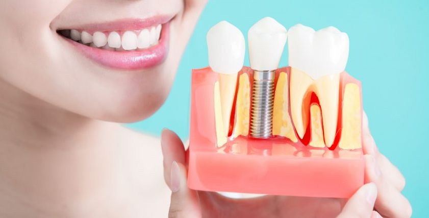 جراح تجميل الأسنان يوضح سهولة عملية زرع الضروس بدلا من بردها