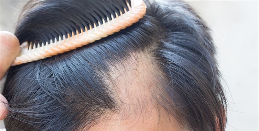طرق علاج مرض الثعلبة