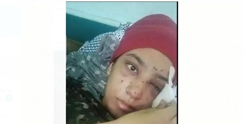 «فاطمة» فقدت عينيها بسبب خرطوش في خناقة