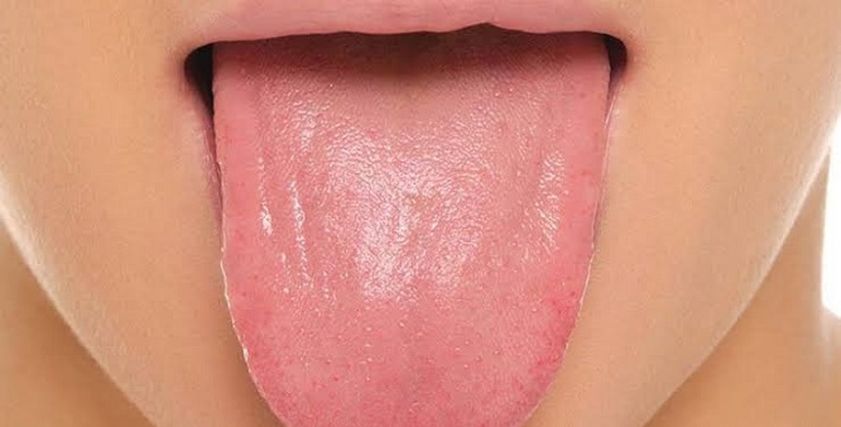 أعراض وعلاج سرطان اللسان