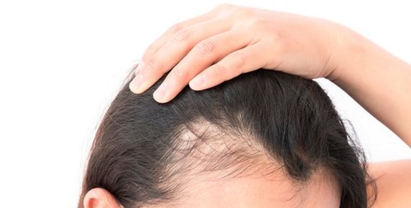 علاج صلع السيدات