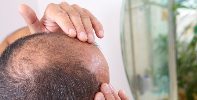 طريقة جديدة لمكافحة الصلع عند الرجال
