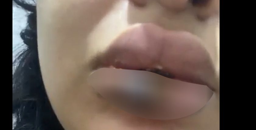 فتاة تتصيب بغرغرينا في الفم