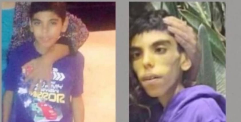 مصطفى قبل إجراء عملية زراعة الجهاز الهضمي