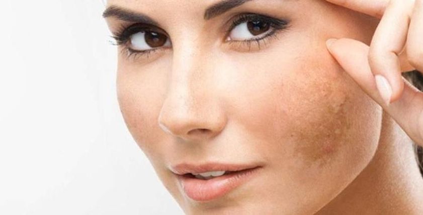 علامات البقع على الوجه