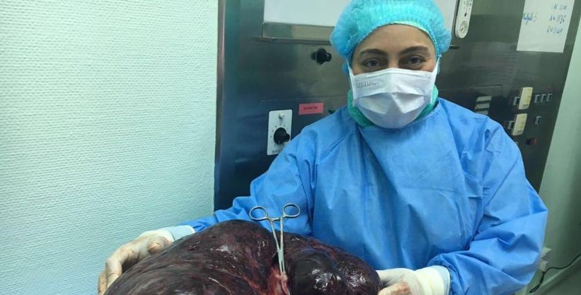العملية استغرقت 3 ساعات تم خلالها إزالة رحم ومبيضي المريضة