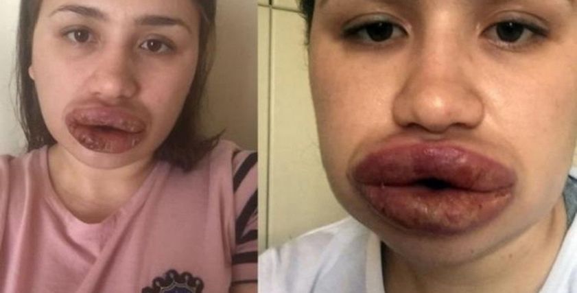 طبيب مزيف يشوه شفاه فتاة