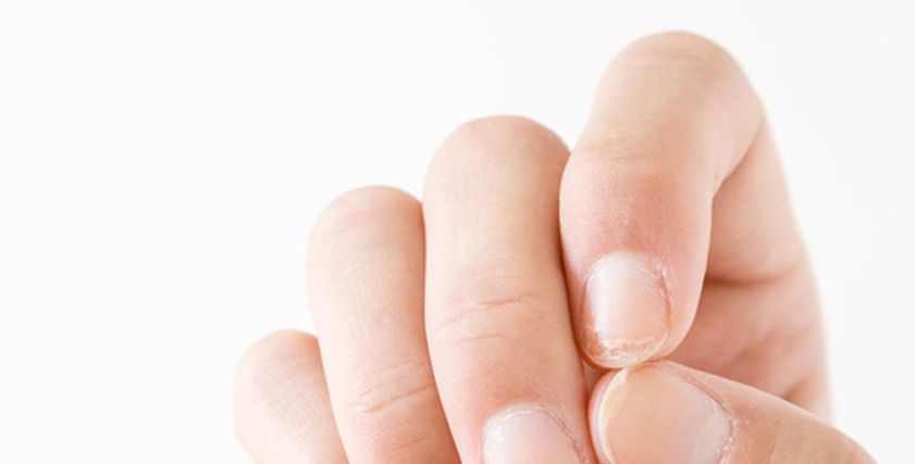 علاج تقصف الأظافر
