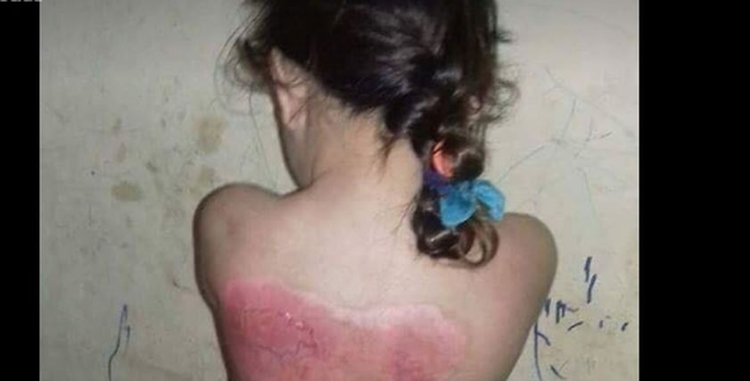 طفلة 5 سنوات تصاب بحروق في مناطق متفرقة من الجسم وتحتاج إلى المساعدة لعلاجها