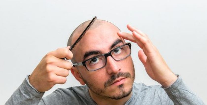علاج الصلع عند الرجال
