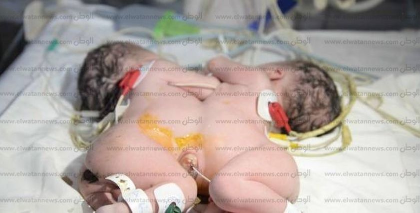 بالصور| بعد ولادة طفل برأسين في أسوان.. أغرب حالات الولادة في مصر
