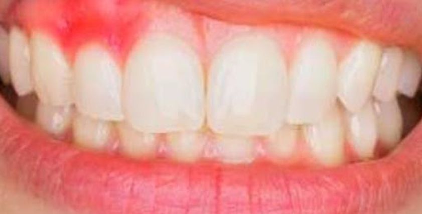 أعراض التهاب اللثة