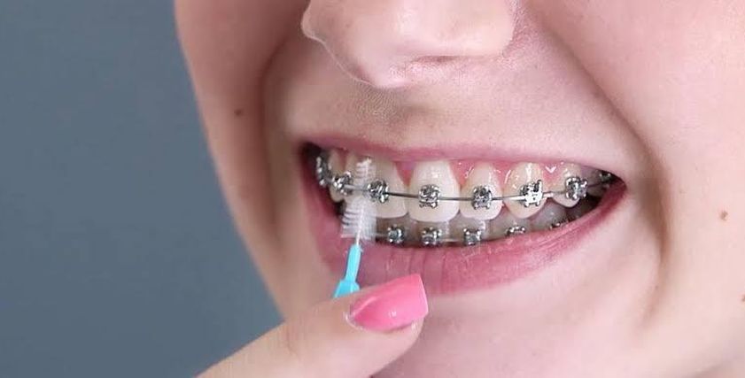 أستاذ تجميل أسنان ناصحا يجب الحفاظ على نظافة الاسنان أثناء التقويم