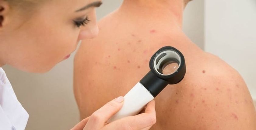  علاج حبوب الظهر والكتف للنساء
