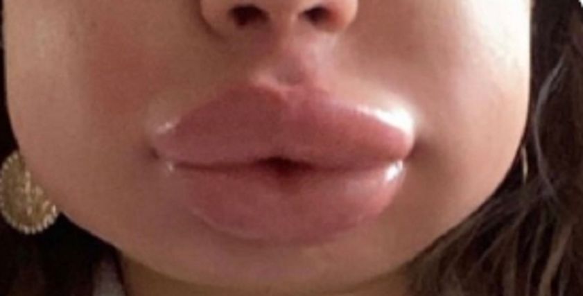 عملية تجميل غير ناجحة- صورة تعبيرية
