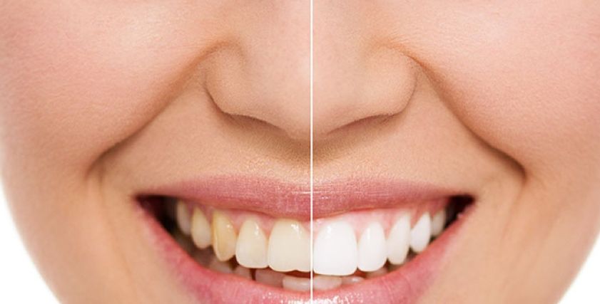 العلاقة بين فيروس كورونا وقلة غسل الاسنان