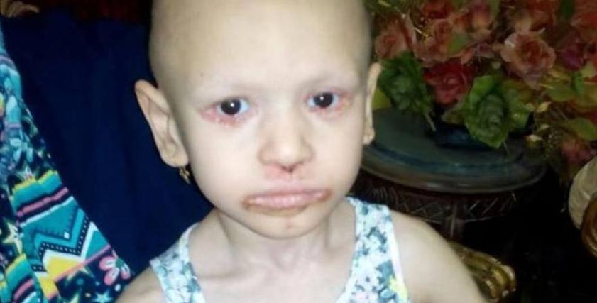 طفلة 4 سنوات تعاني من مرض جلدي نادر يؤدي إلى تساقط جلدها