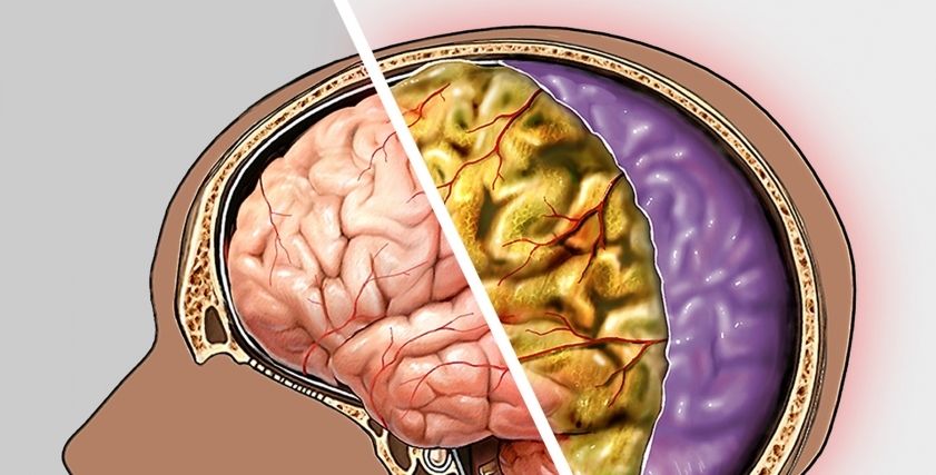 أعراض الالتهاب السحائي وعلاجه