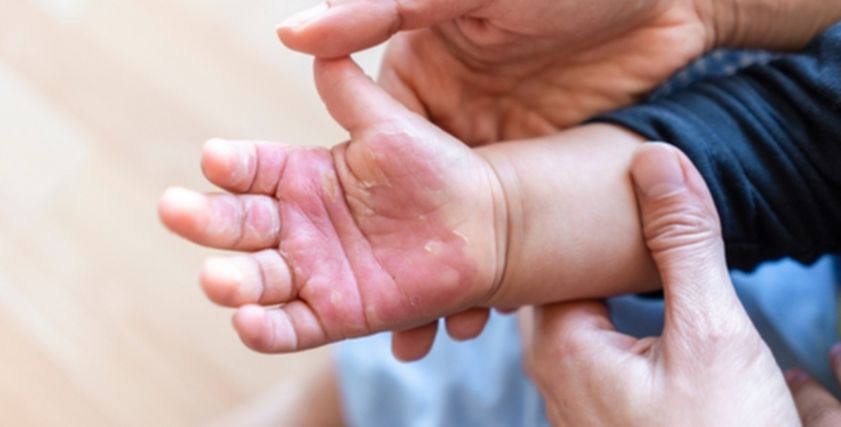 علاج الحروق عند الأطفال في المنزل